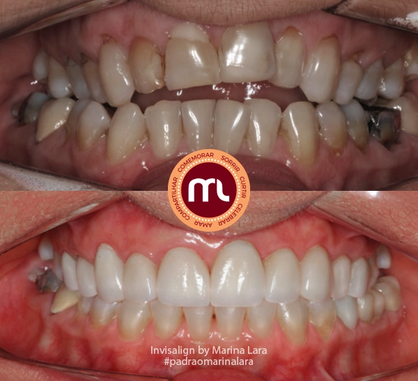 antes-depois-marina-lara-invisalign-1.webp