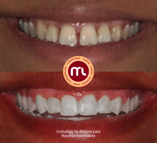 antes-depois-marina-lara-invisalign-20.webp