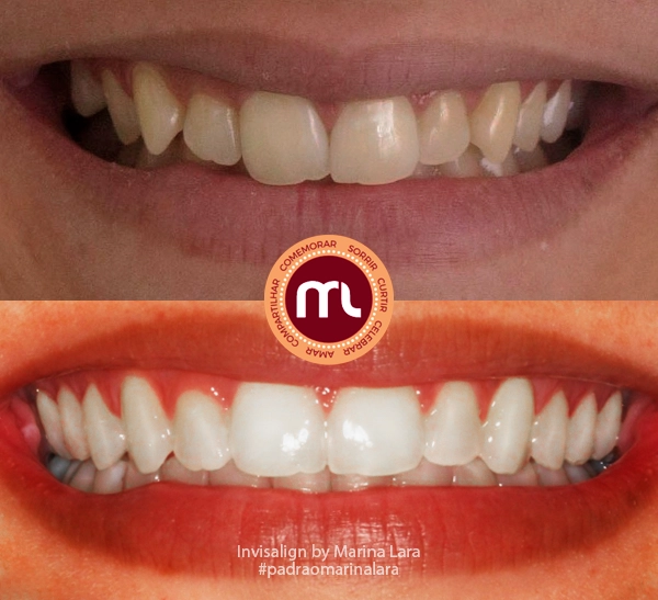 antes-depois-marina-lara-invisalign-3.webp