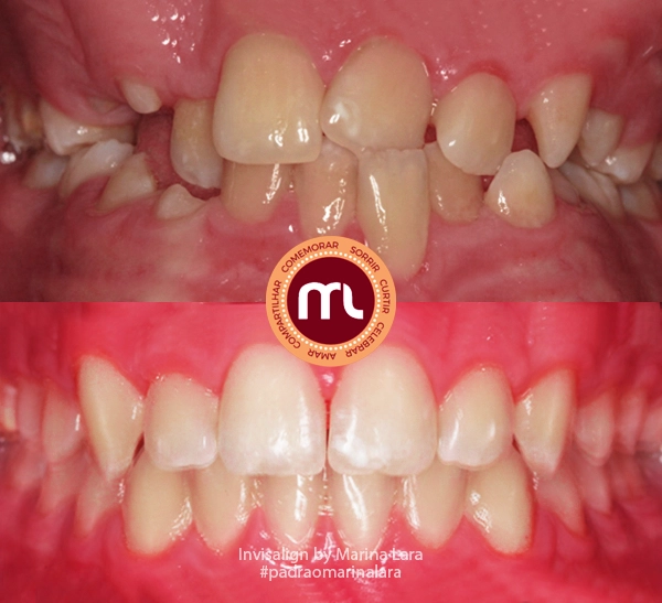 antes-depois-marina-lara-invisalign-40.webp