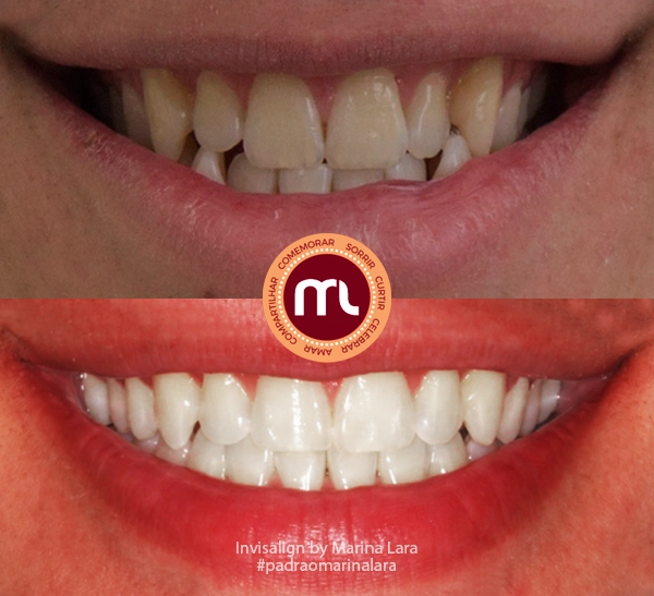 antes-depois-marina-lara-invisalign-5.webp
