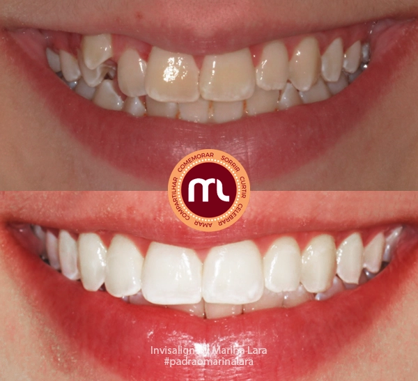 antes-depois-marina-lara-invisalign-60.webp